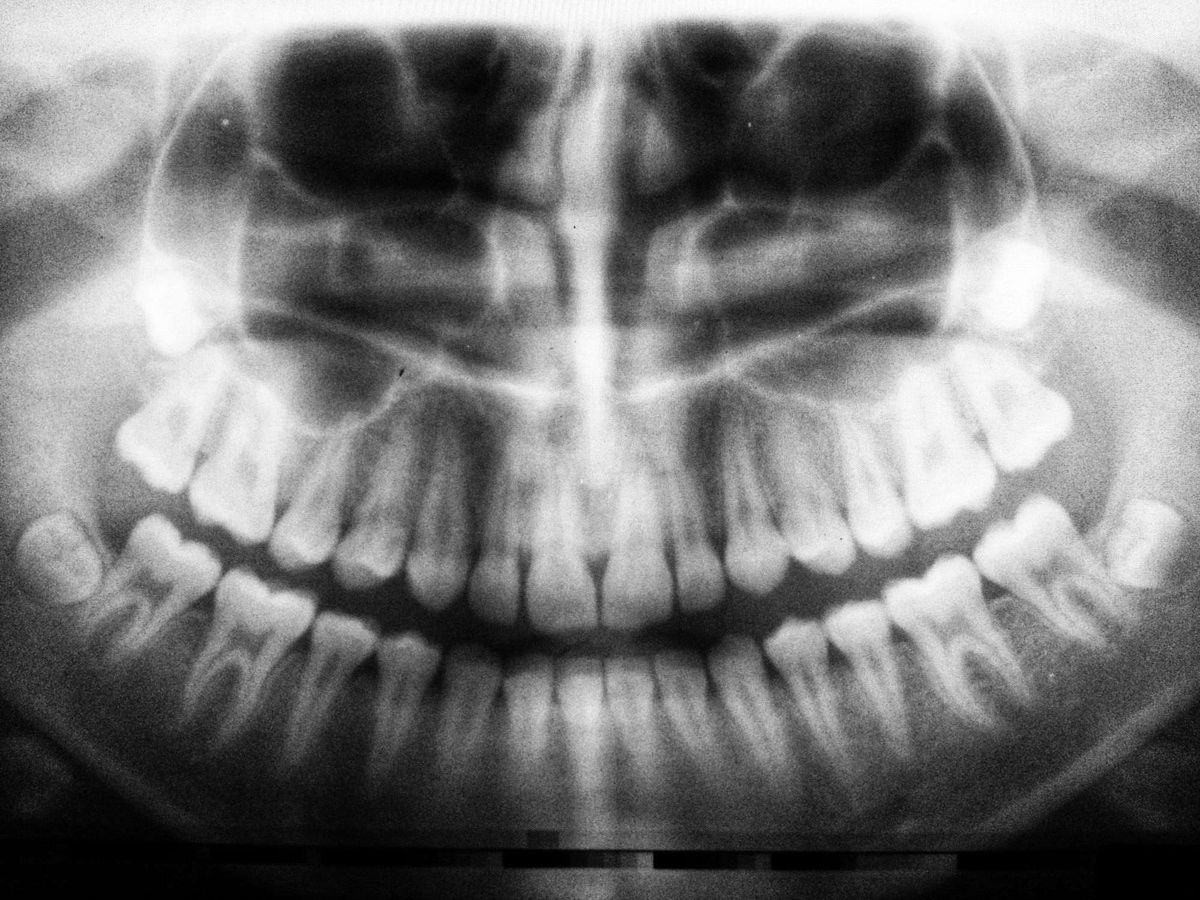 A panoramic dental x-ray showing the position of wisdom teeth