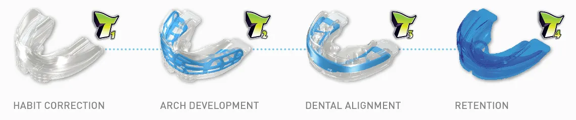 The four-stage Myobrace appliance sequence: habit correction, arch development, dental alignment and retention.