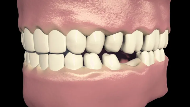 Video still of a supporting tooth being prepared for a bridge