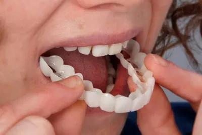 Snap-On Smile arch being pressed onto a lower row of teeth