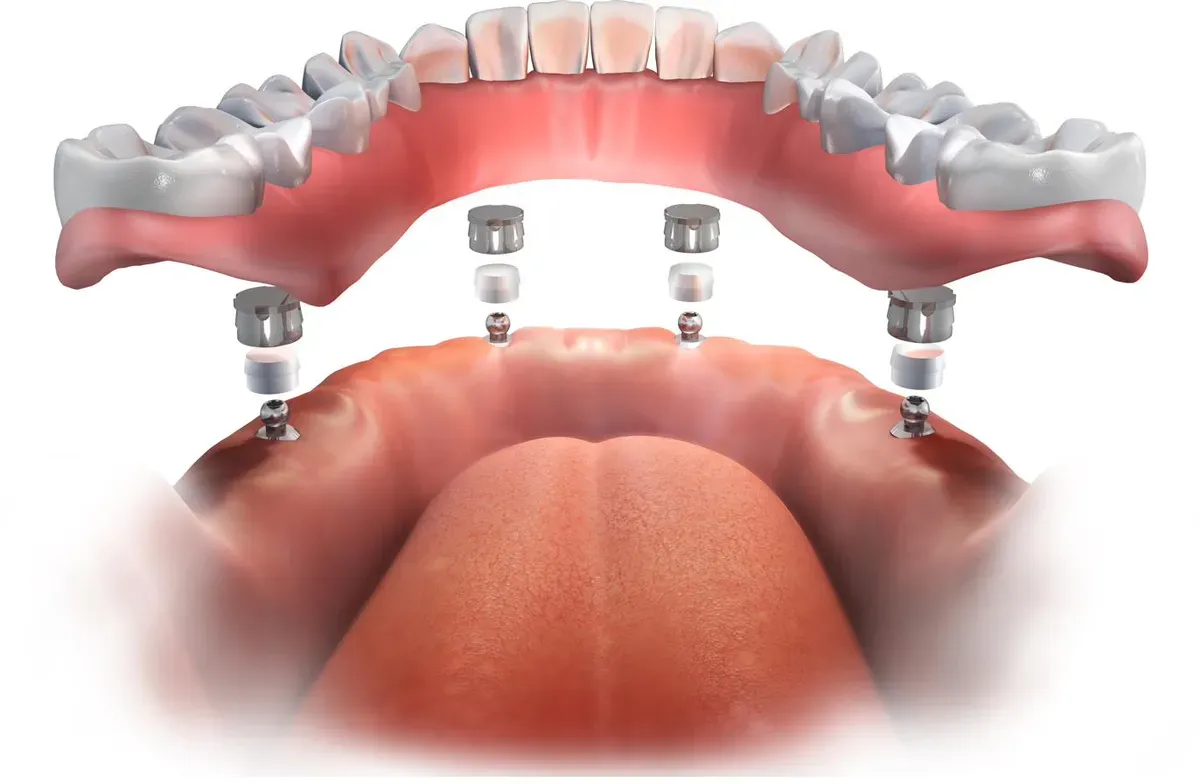 Model of a full arch of teeth supported by implants