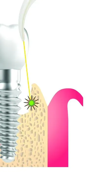Illustration of gum tissue around a dental implant