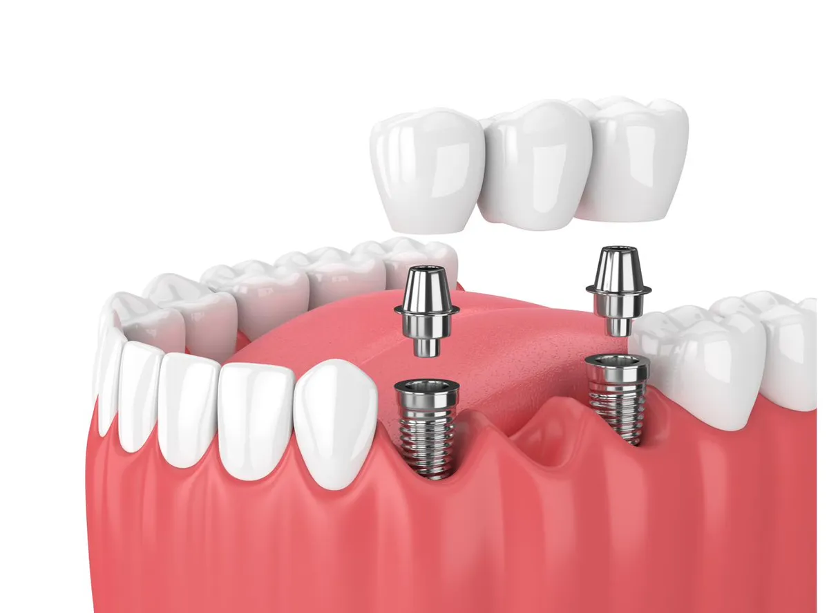 Model of an implant bridge spanning several missing teeth