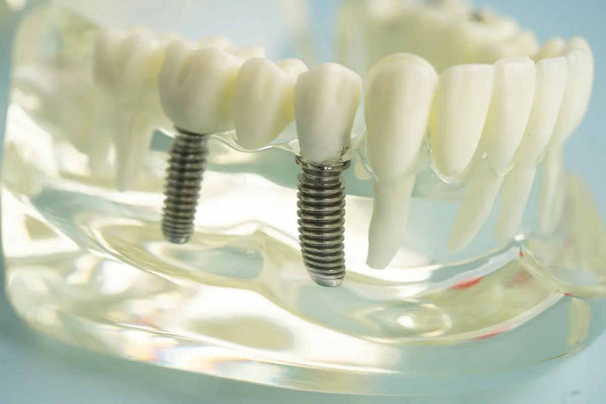 Model of an implant bridge replacing several neighbouring teeth