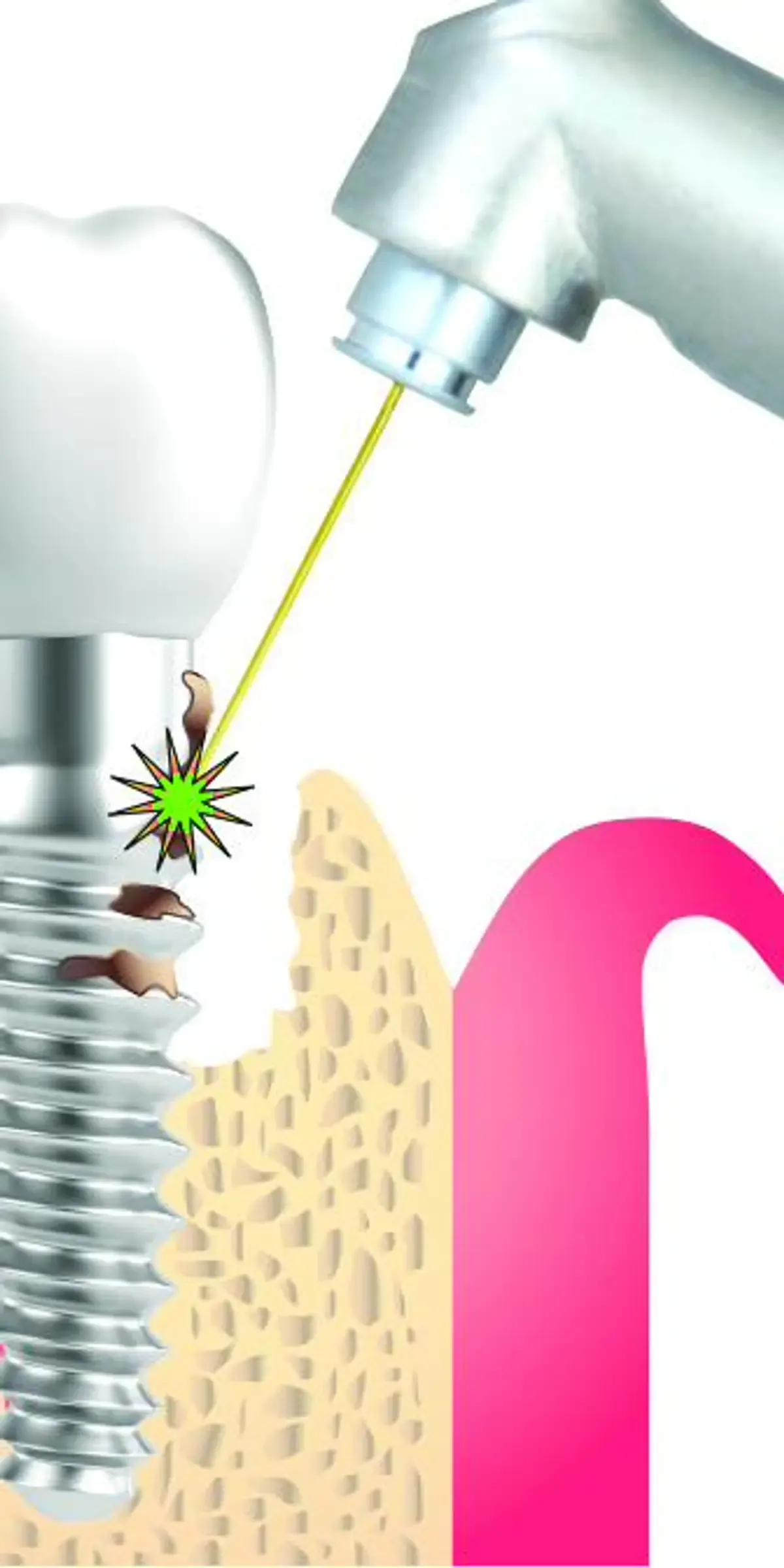 Illustration of gum tissue around a dental implant