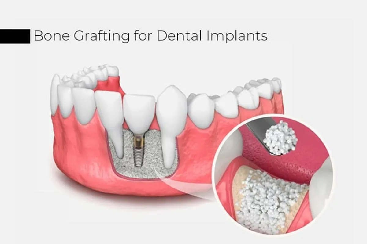Illustration of a bone graft at a dental implant site