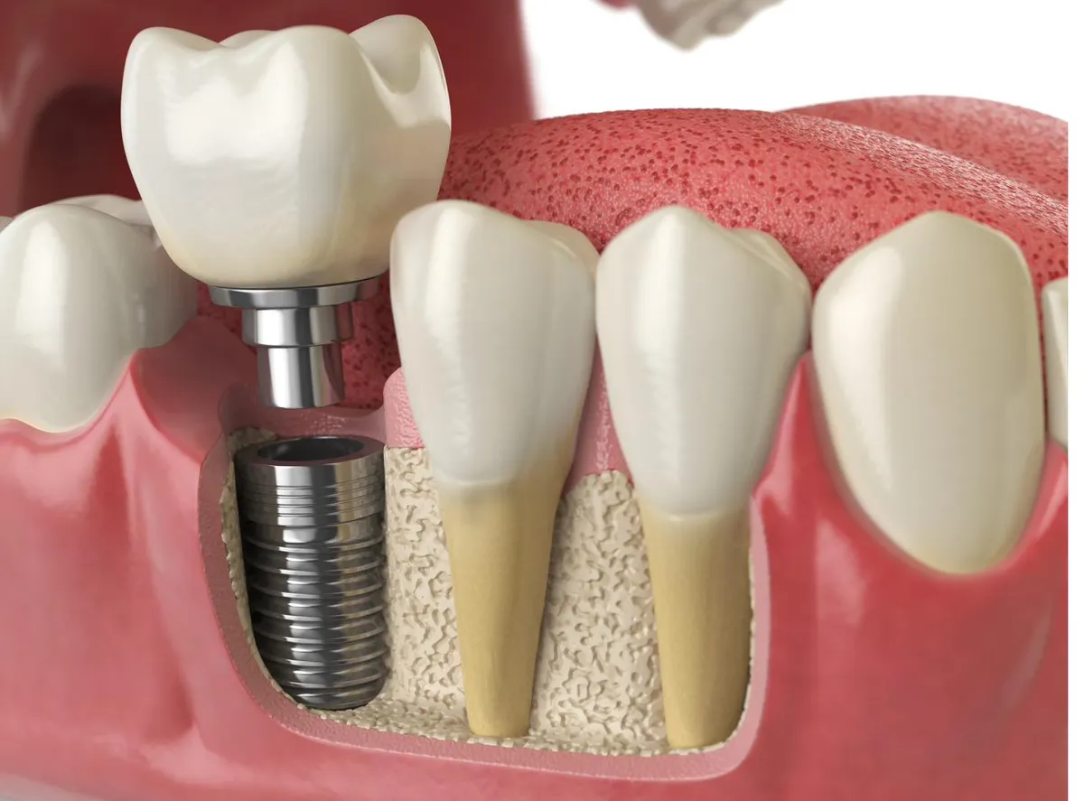Model of a single implant post in the jawbone
