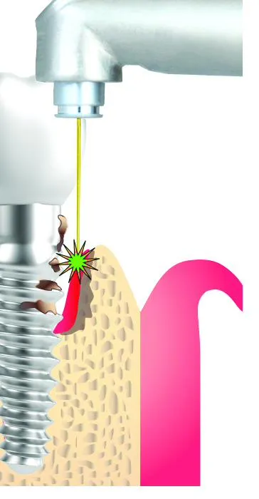 Illustration of gum tissue around a dental implant