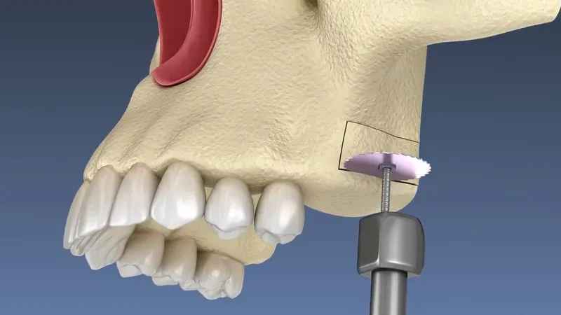 3D render of a sinus lift in the upper jaw