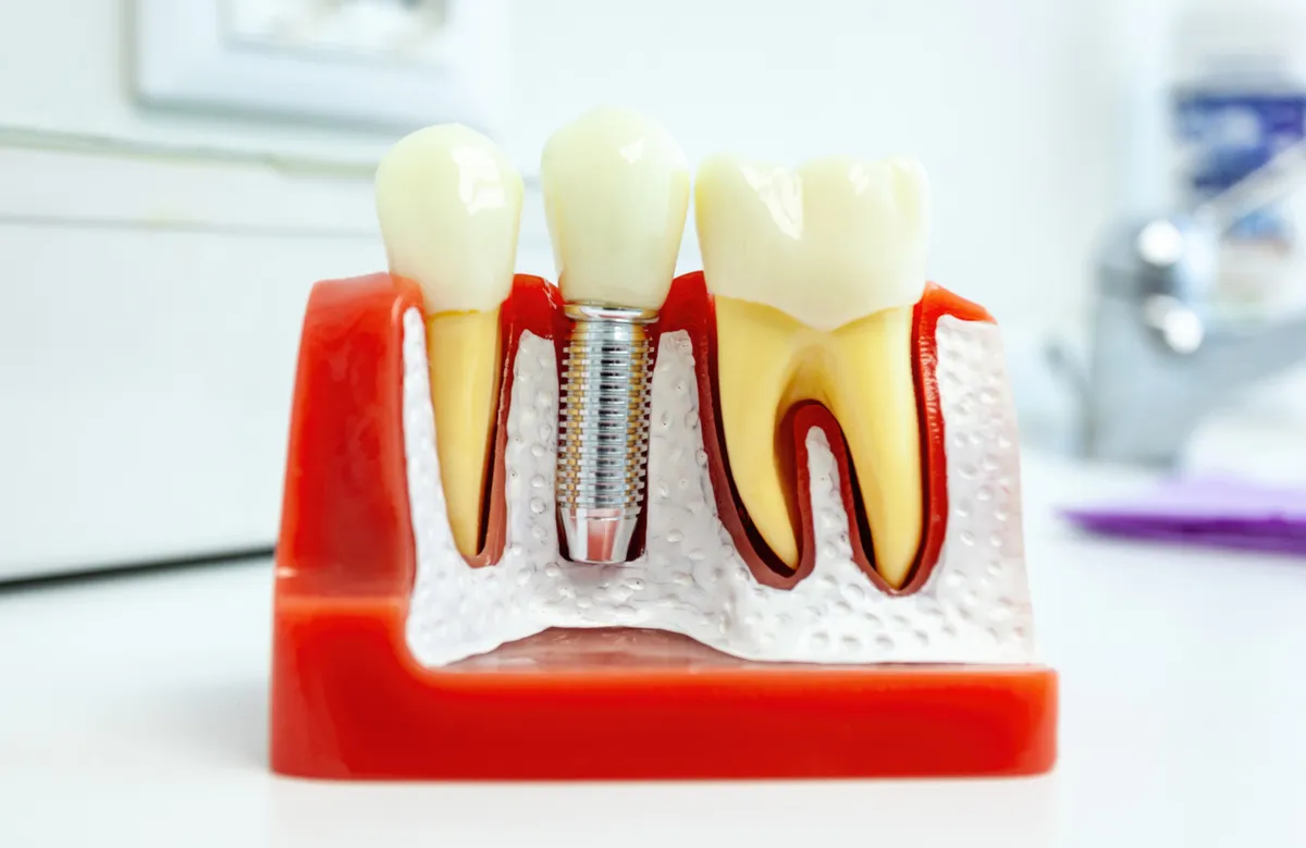 Model of a single dental implant with its crown