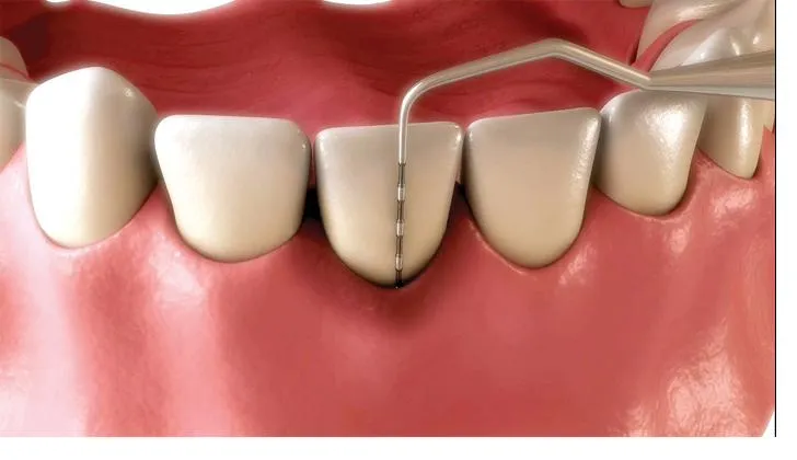 Illustration of a periodontal probe measuring the depth of the gum pocket beside a tooth