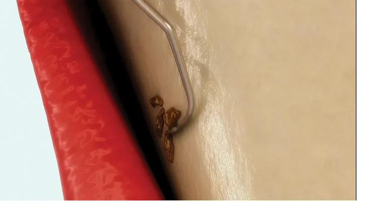 Illustration of an instrument cleaning the root surface of a tooth below the gumline