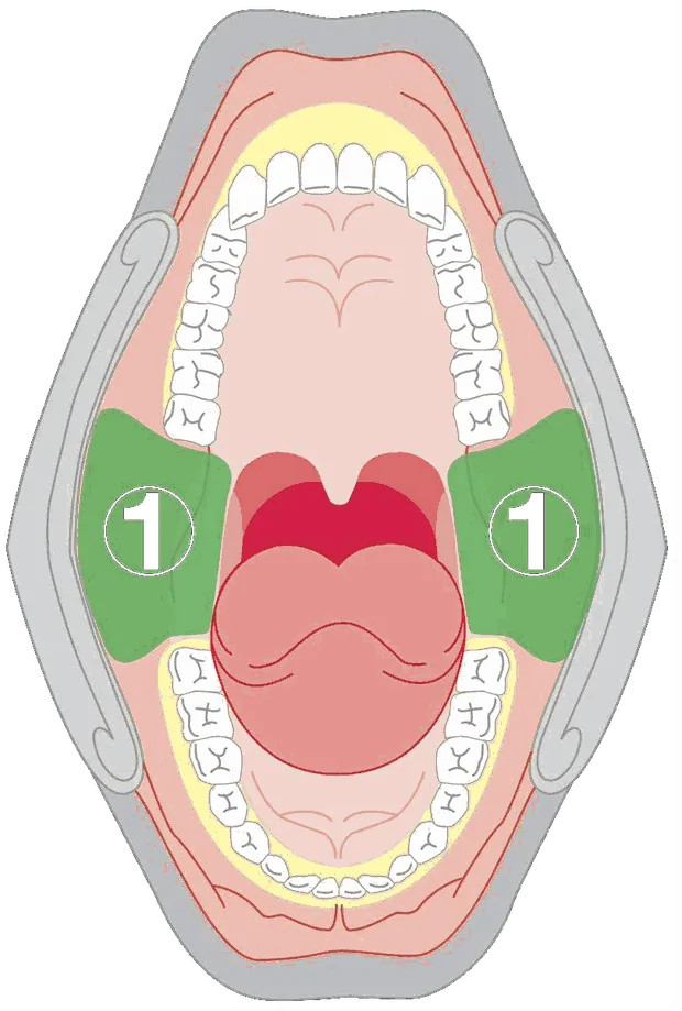 Diagram of the inside of the mouth with the tonsillar pillars at each side of the throat marked as zone one.