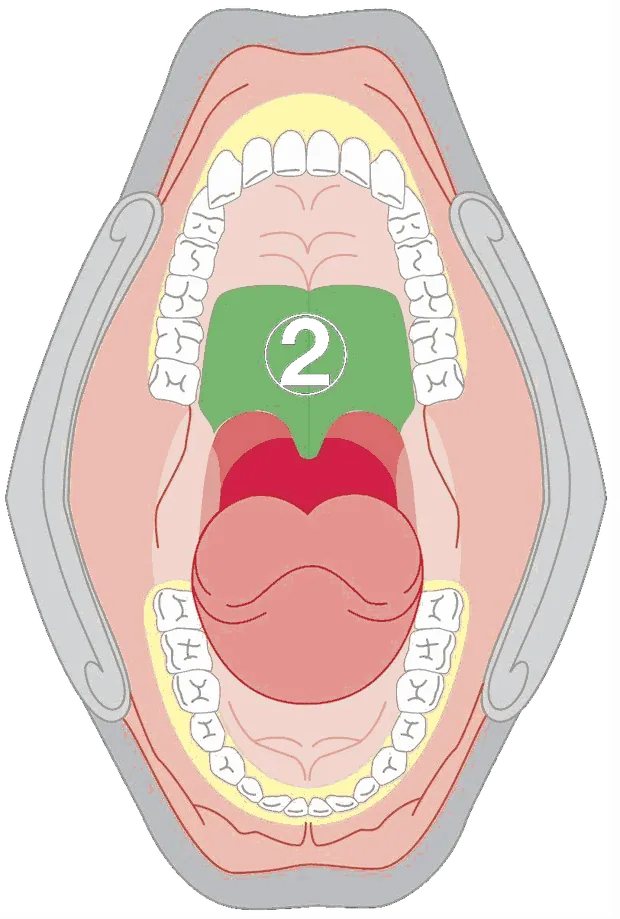 Diagram of the inside of the mouth with the soft palate marked as zone two.