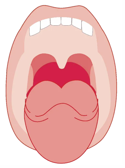 Illustration of an open mouth with the soft palate and tonsil area at the back of the throat shaded red.
