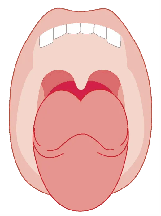 Illustration of an open mouth showing a smaller tonsil area at the sides of the throat.