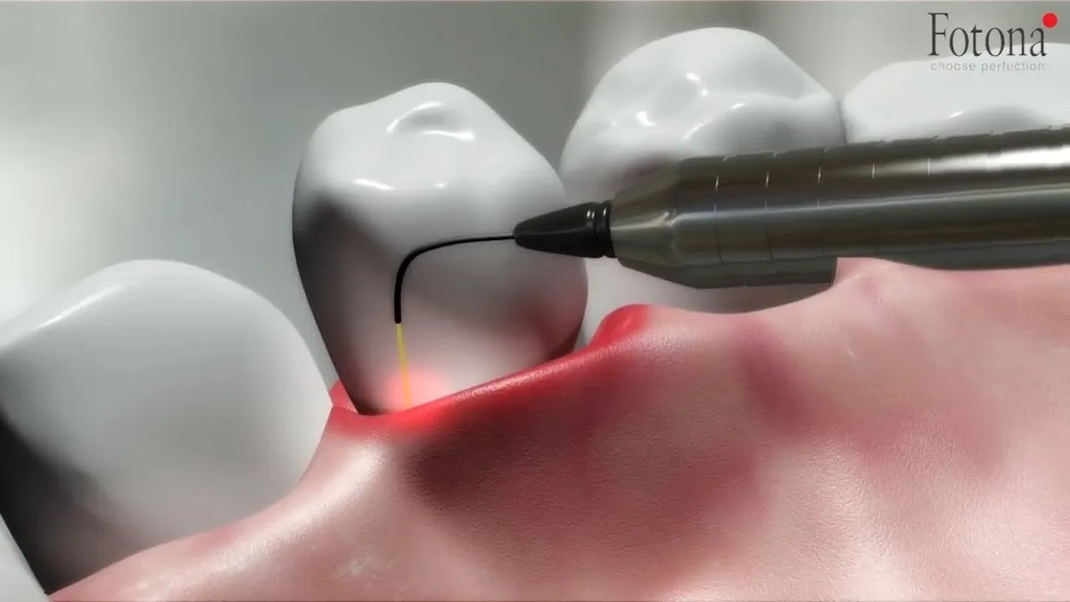 Video thumbnail: laser-assisted periodontal therapy explained, opens on YouTube
