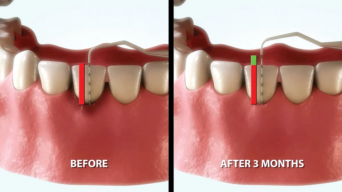 Clinical illustration comparing gum pocket depth at the start of treatment and at a later review