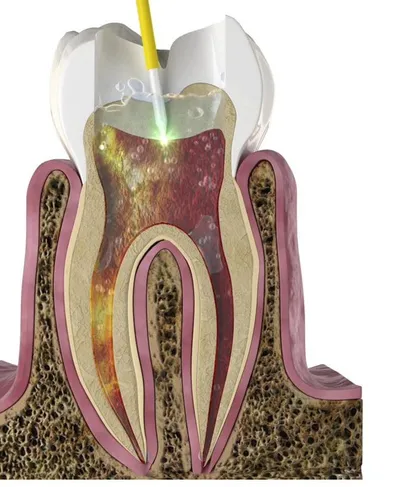Illustration of a laser tip at the top of a root canal with cleaning solution flowing into the side branches