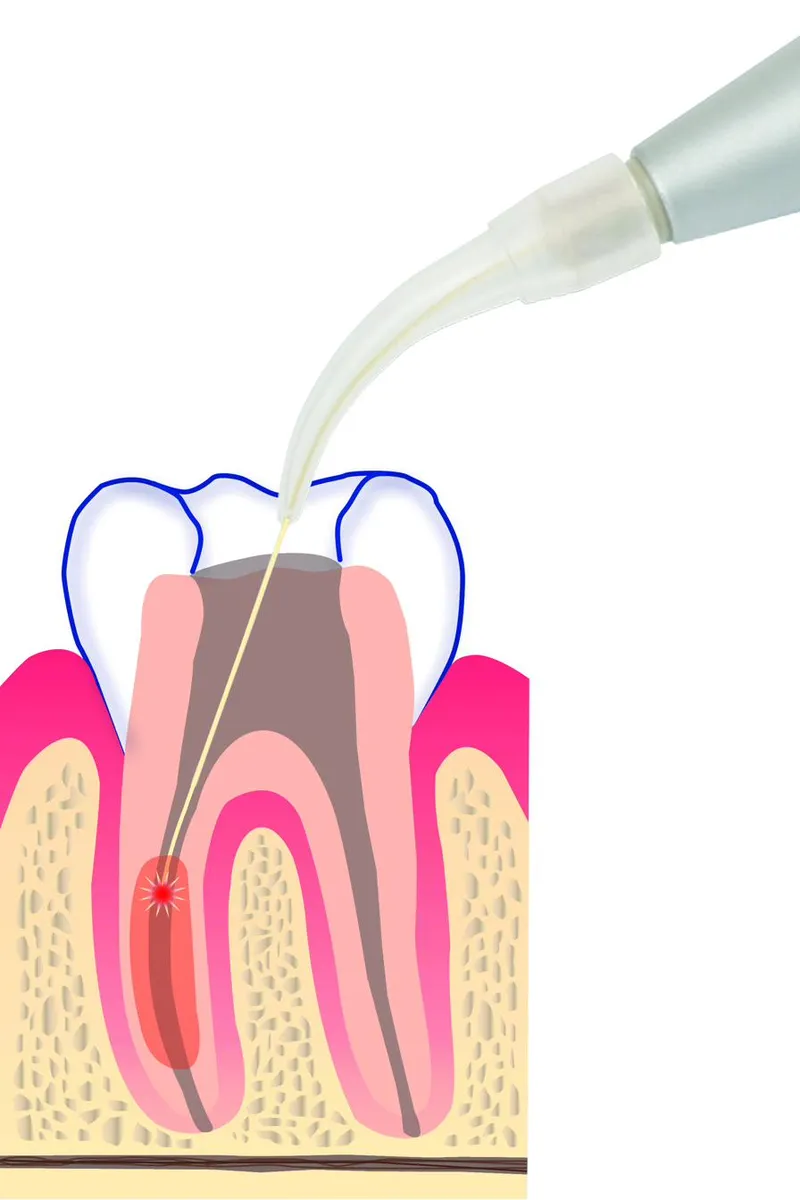 Laser light being applied across the surface of a tooth