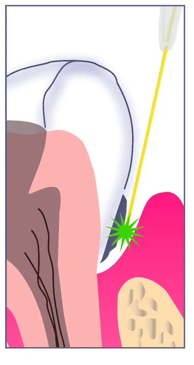 Cross-section illustration of laser energy reaching bacteria at the base of a deep gum pocket