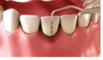 Diagram of a gum pocket being measured around an inflamed tooth