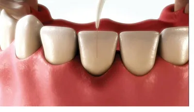 Illustration of a fine laser tip placed along the gum edge