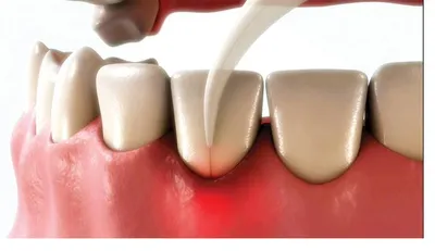 3D illustration of a fine laser tip placed gently between gum and tooth