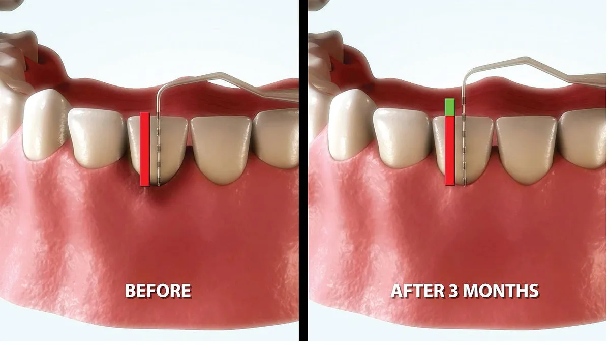 Illustration comparing gum pocket depth at the start of treatment and at a later review; for education only.