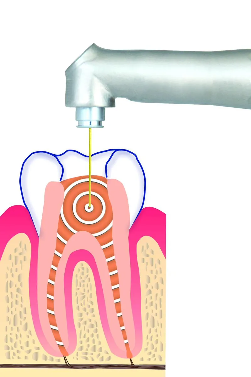 Cross-section illustration of mid-infrared laser light acting on water-rich tissue at a tooth root.