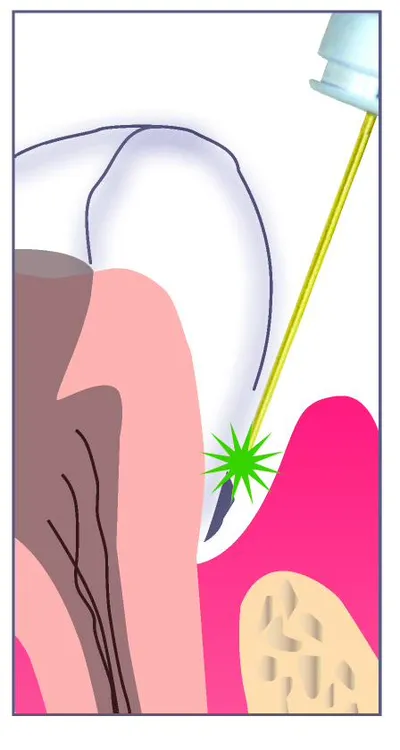 Illustration of the first step: near-infrared laser light delivered into a gum pocket to target bacteria and inflamed tissue.