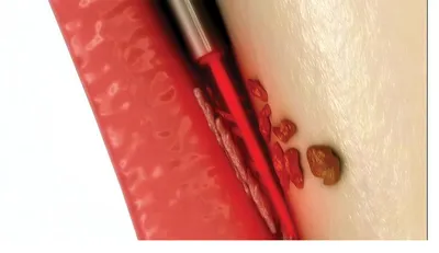 Illustration of the second step: mid-infrared laser light used to remove tartar from the root surface inside a gum pocket.