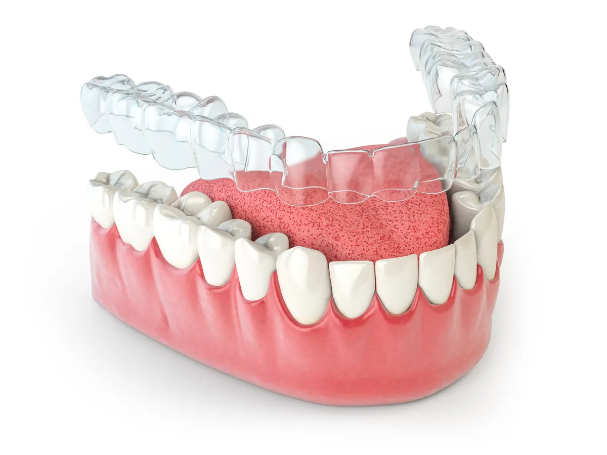 Clear aligner tray fitted over a model of the lower teeth
