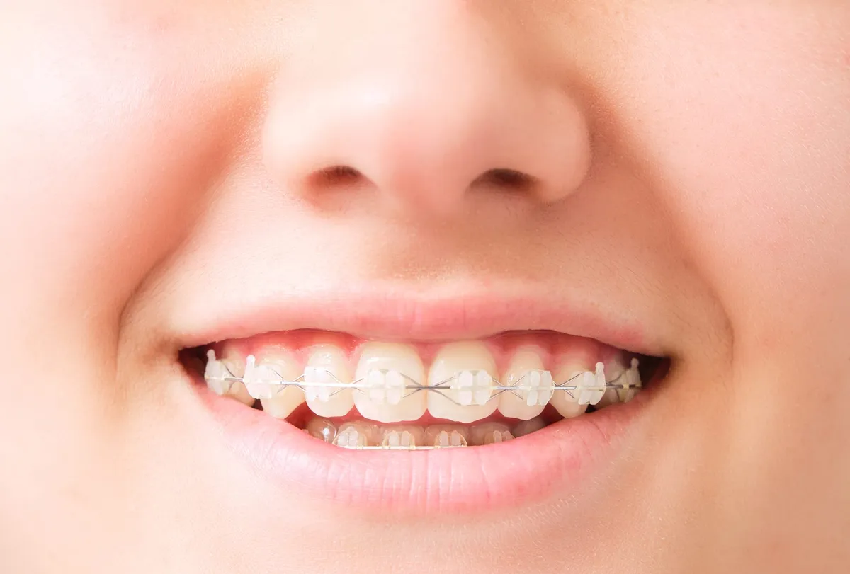 Tooth-coloured ceramic brackets on a row of teeth, close up