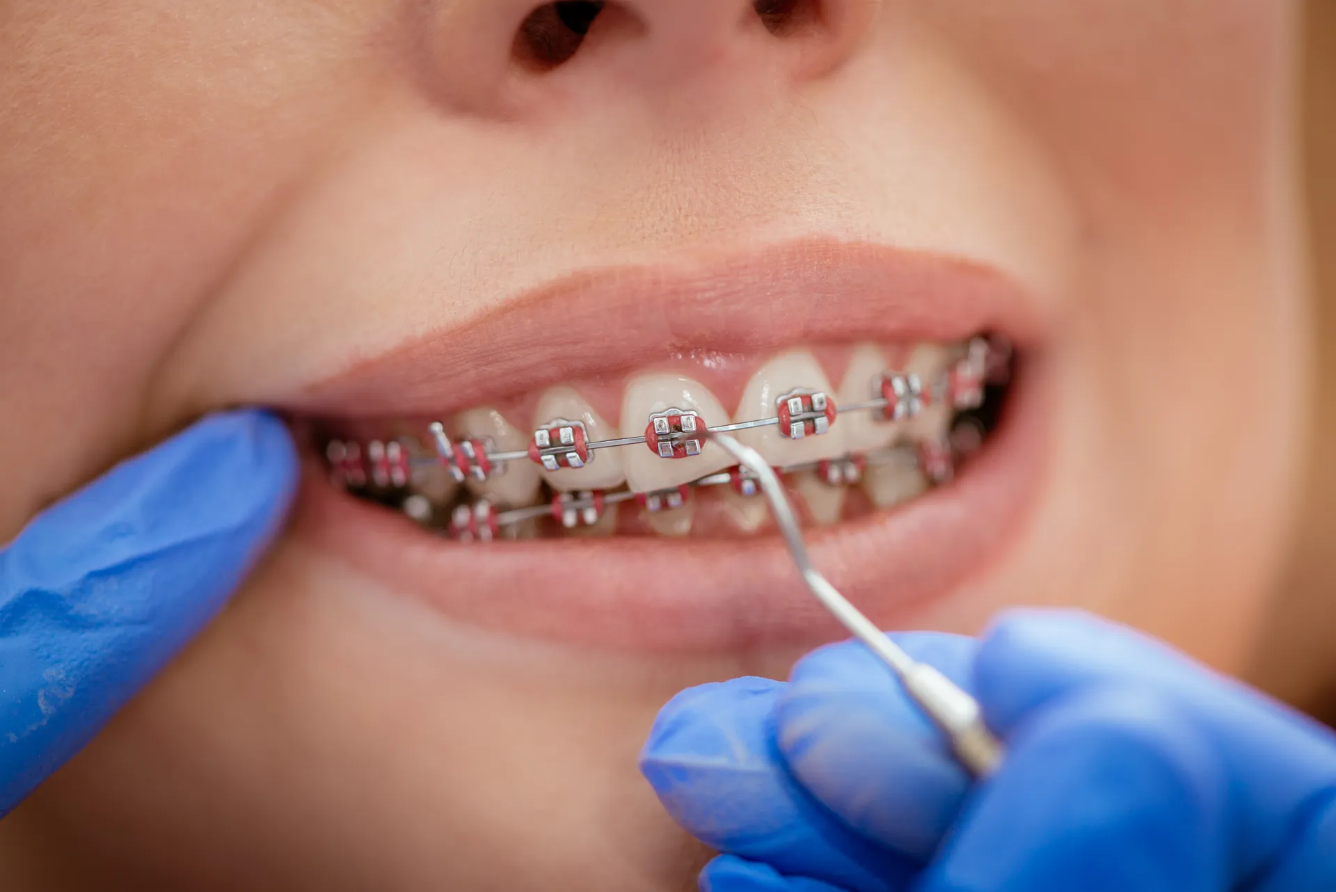 Metal braces on a patient's teeth beside an orthodontic instrument, close up