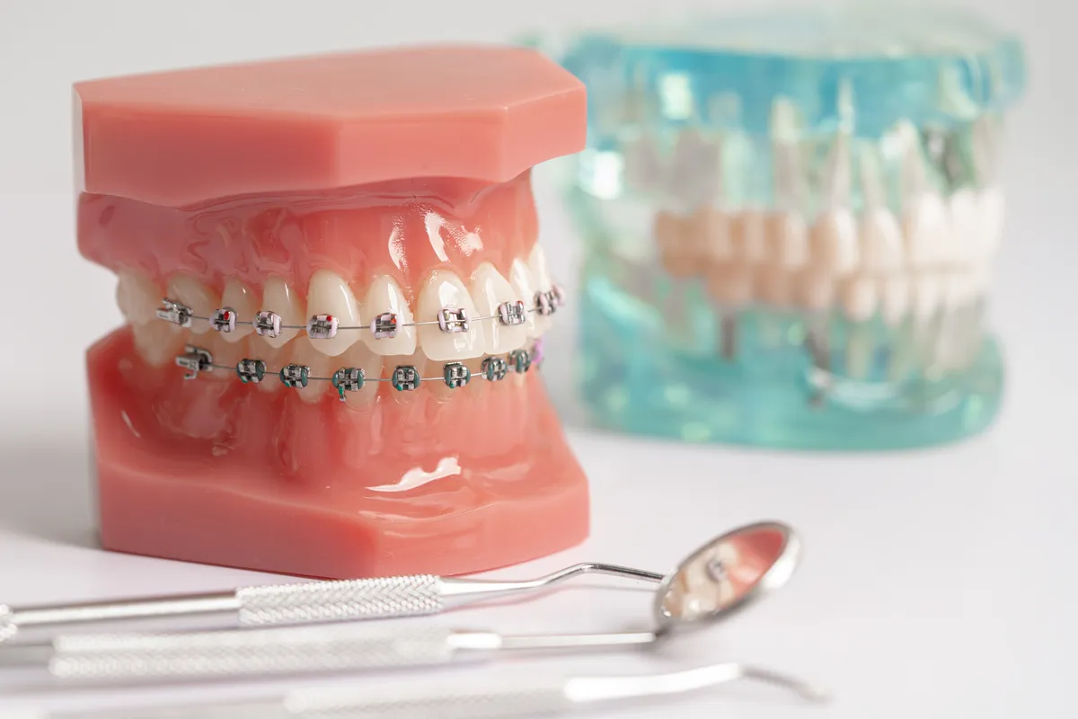 Orthodontic planning instruments laid beside a model of teeth